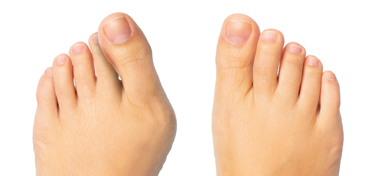 Woman feet with and without bunion